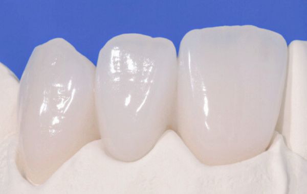 Răng sứ từ nguyên vật liệu sứ nha khoa thủy tinh